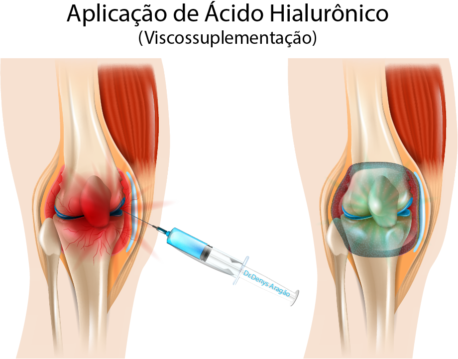 Aplicação de Ácido Hialurônico | Dr. Denys Aragão