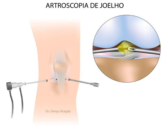 Artroscopia do Joelho | Dr. Denys Aragão
