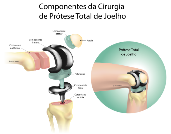 Componentes da Cirurgia de Prótese Total de Joelho | Dr. Denys Aragão