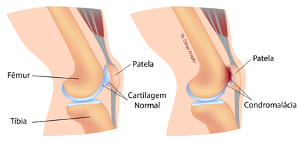 O que é Condromalácia Patelar | Dr. Denys Aragão