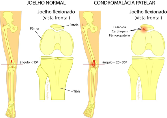 Causas do Condromalácia Patelar | Dr. Denys Aragão