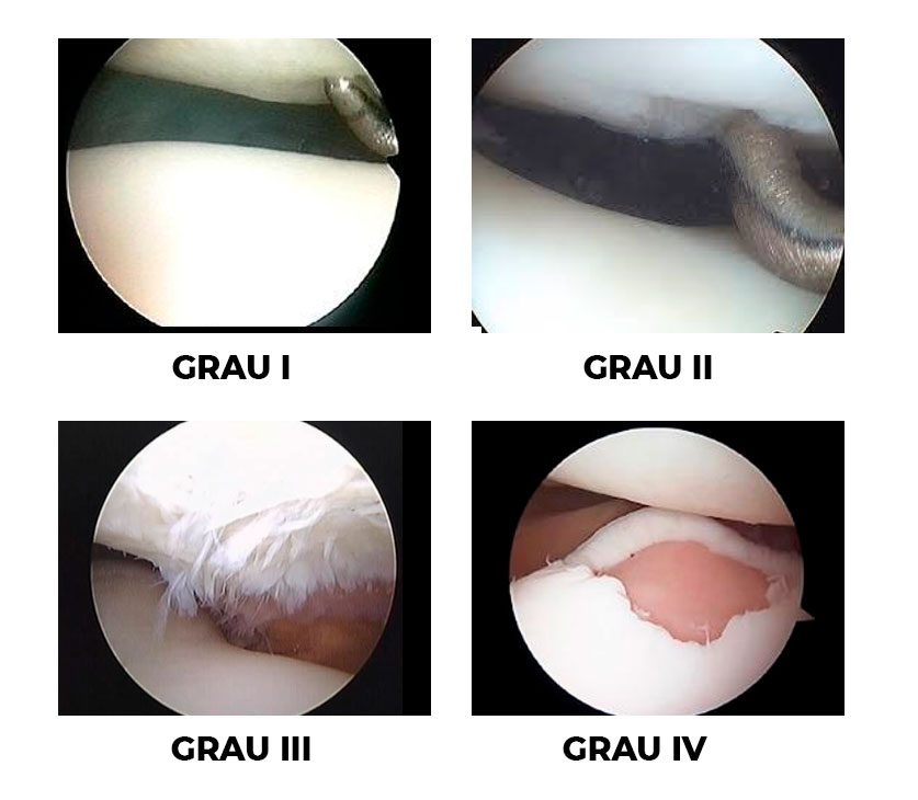 Graus do Condromalácia Patelar | Dr. Denys Aragão