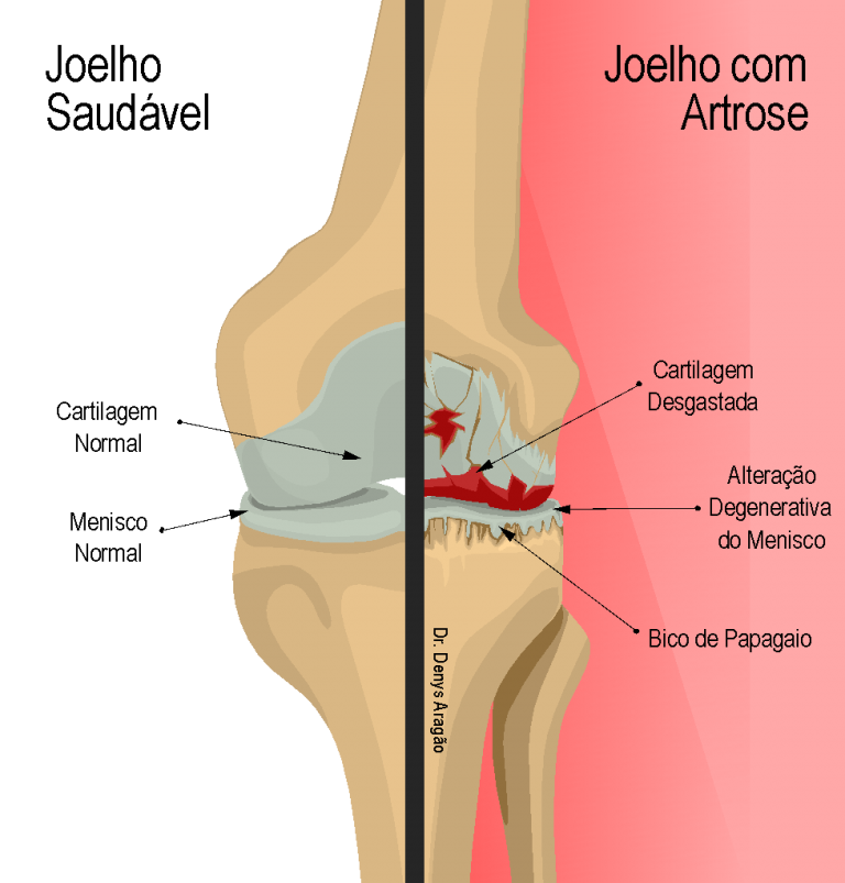 Diferença entre Joelho saudável e Joelho com Artrose | Dr. Denys Aragão