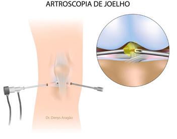 Artroscopia de joelho | Dr. Denys Aragão