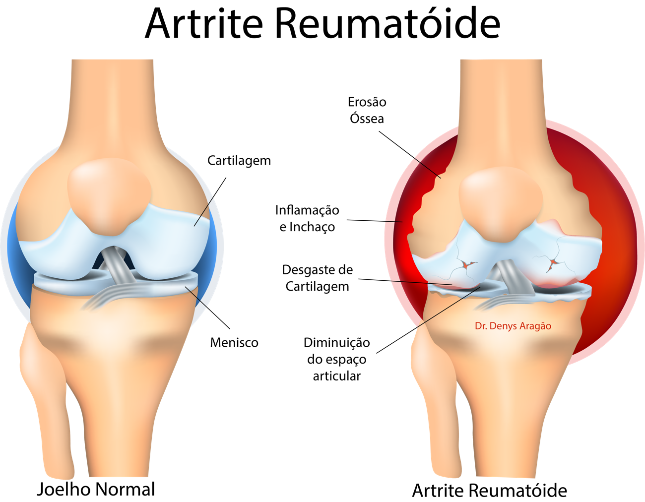 Artrite Reumatóide | Dr. Denys Aragão