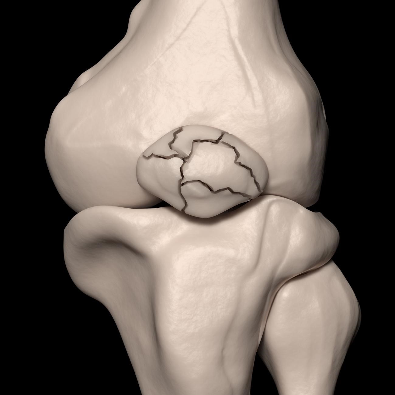 Fratura cominutiva | Dr. Denys Aragão