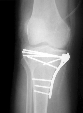 Fratura de Platô Tibial fixada com placa e parafusos