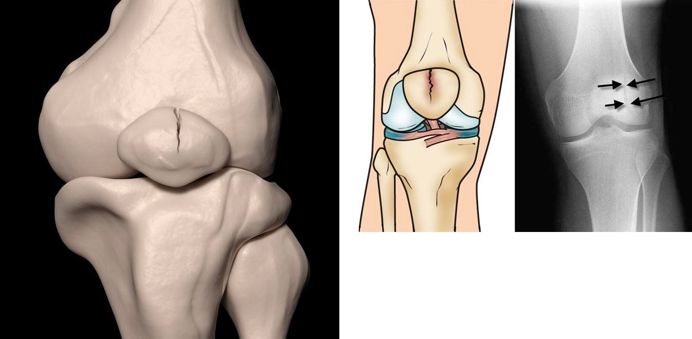 A ilustração e o raio-x mostram uma fratura vertical e estável da patela