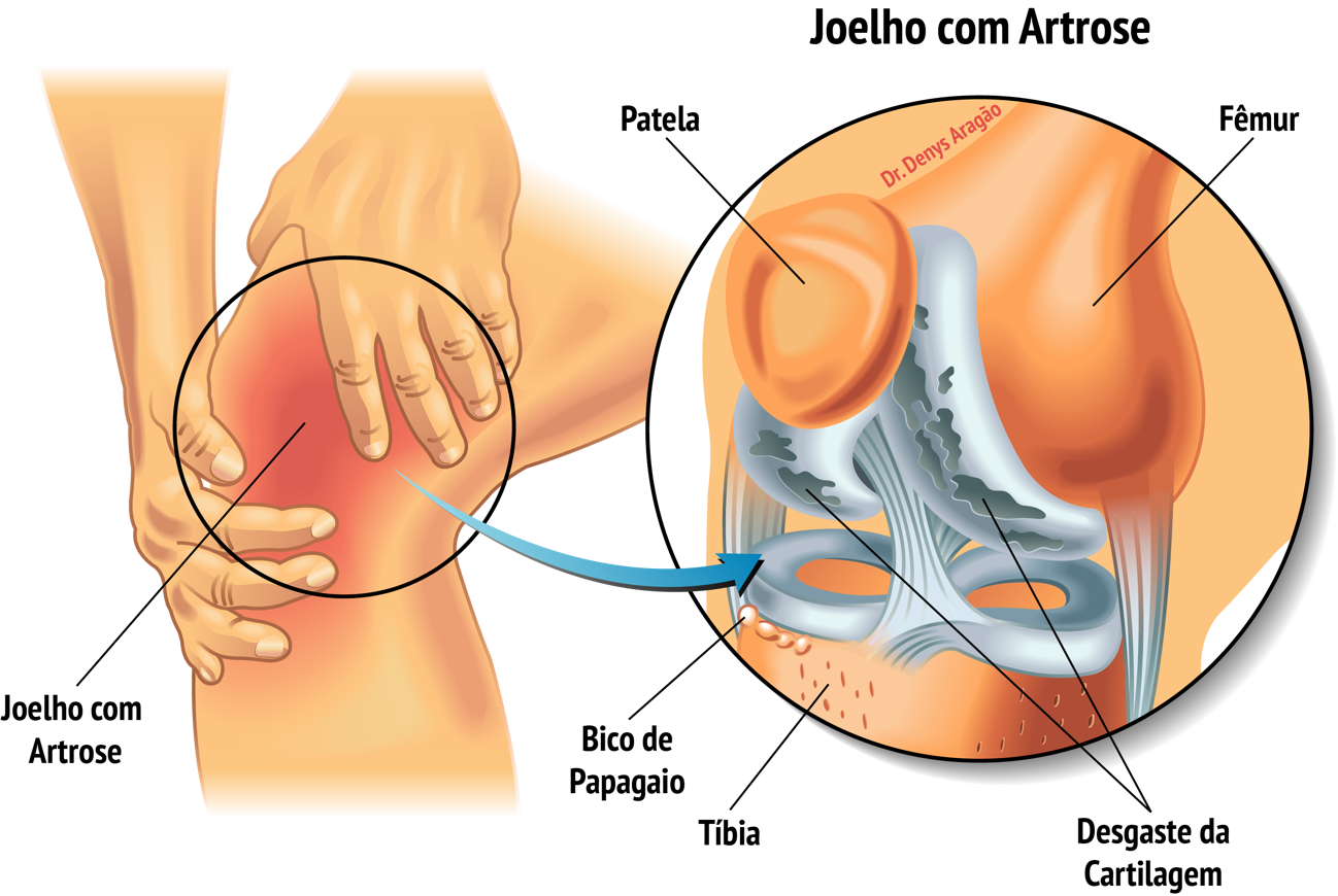Joelho com Artrose | Dr. Denys Aragão
