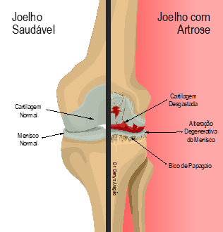 Joelho saudável e joelho com Artrose | Dr. Denys Aragão