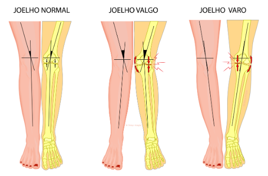 Joelho Valgo e Joelho Varo | Dr. Denys Aragão