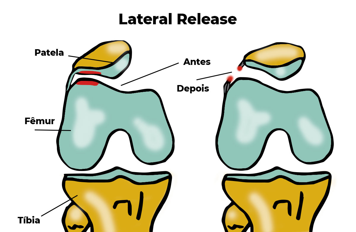 Procedimento de liberação lateral | Dr. Denys Aragão