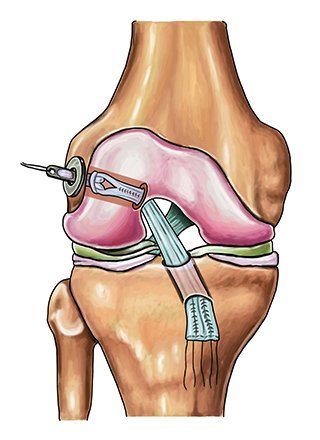 Ligamento Cruzado Anterior reconstruído