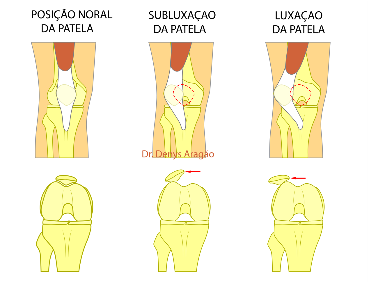 Luxação de patelar | Dr. Denys Aragão