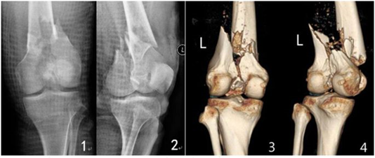 Rx e Tomografia de uma fratura de fêmur distal