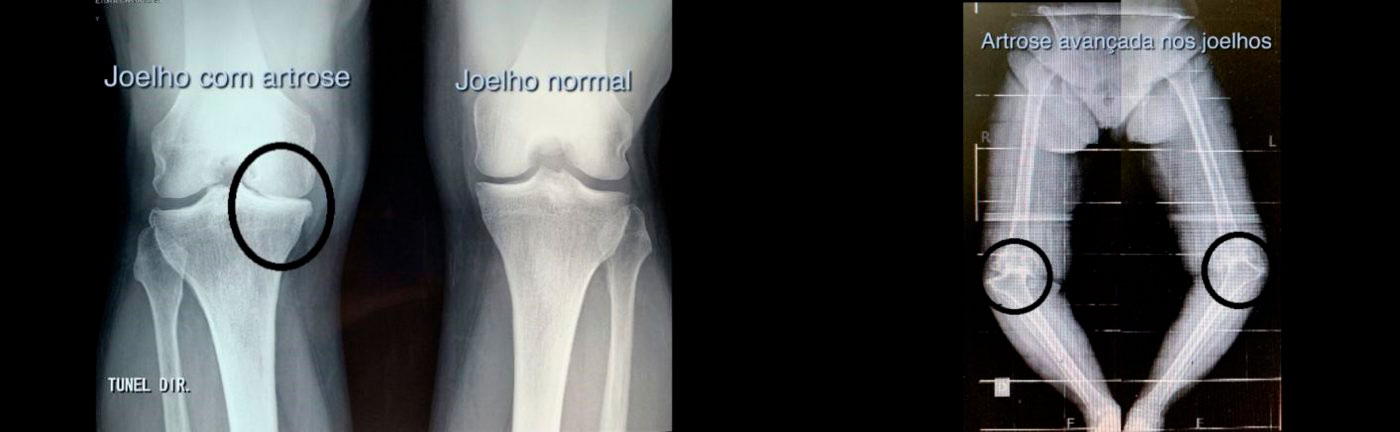 Raio-x joelho com Artrose | Dr. Denys Aragão
