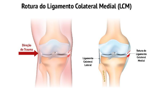 Rotura do Ligamento Colateral Medial | Dr. Denys Aragão