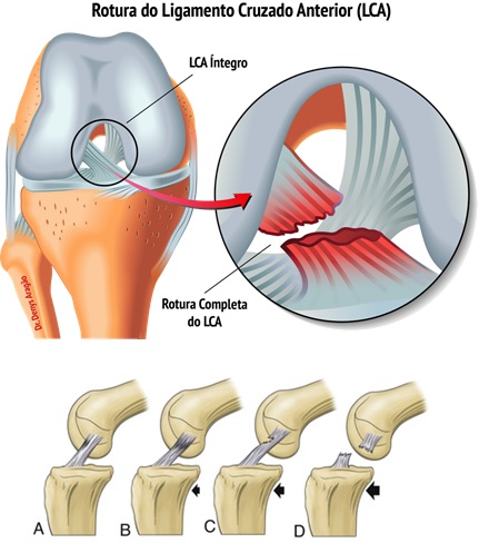 Rotura do Ligamento Cruzado Anterior - LCA | Dr. Denys Aragão