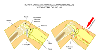Rotura do Ligamento Cruzado Posterior | Dr. Denys Aragão