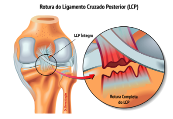 Rotura do Ligamento Cruzado Posterior | Dr. Denys Aragão