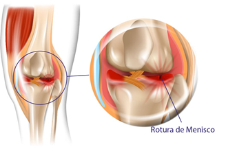 Rotura de Menisco | Dr. Denys Aragão