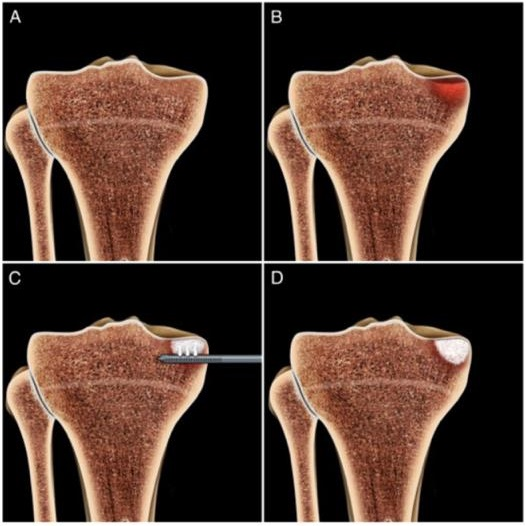 Subcondroplastia Dr. Denys Aragão