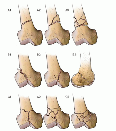 Tipos de fratura de fêmur distal | Dr. Denys Aragão