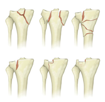 Tipos de fratura de Platô Tibial | Dr. Denys Aragão