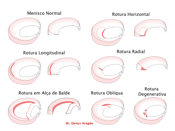 Tipos de Rotura do Menisco | Dr. Denys Aragão