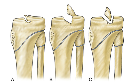 Principais tipos de fraturas de espinha tibial 