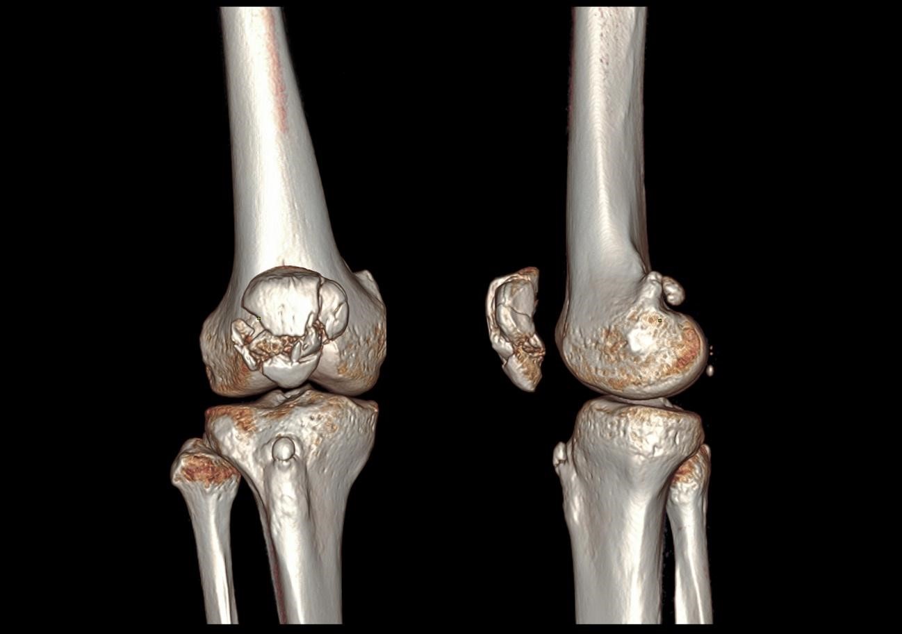 Fratura cominutiva de patela | Dr. Denys Aragão