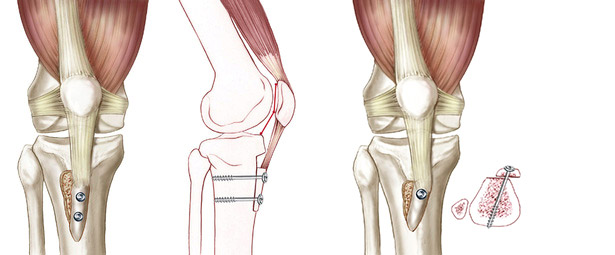 Transferência da Tuberosidade Anterior da Tíbia (TAT) | Dr. Denys Aragão