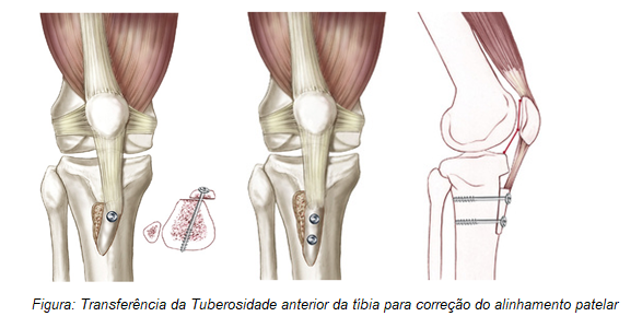 Transferência medial da tuberosidade anterior da tíbia | Dr. Denys Aragão