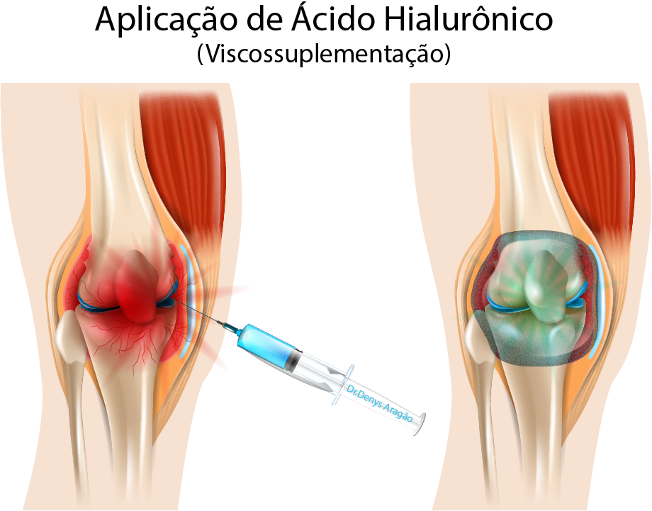 Viscossuplementação Joelho 